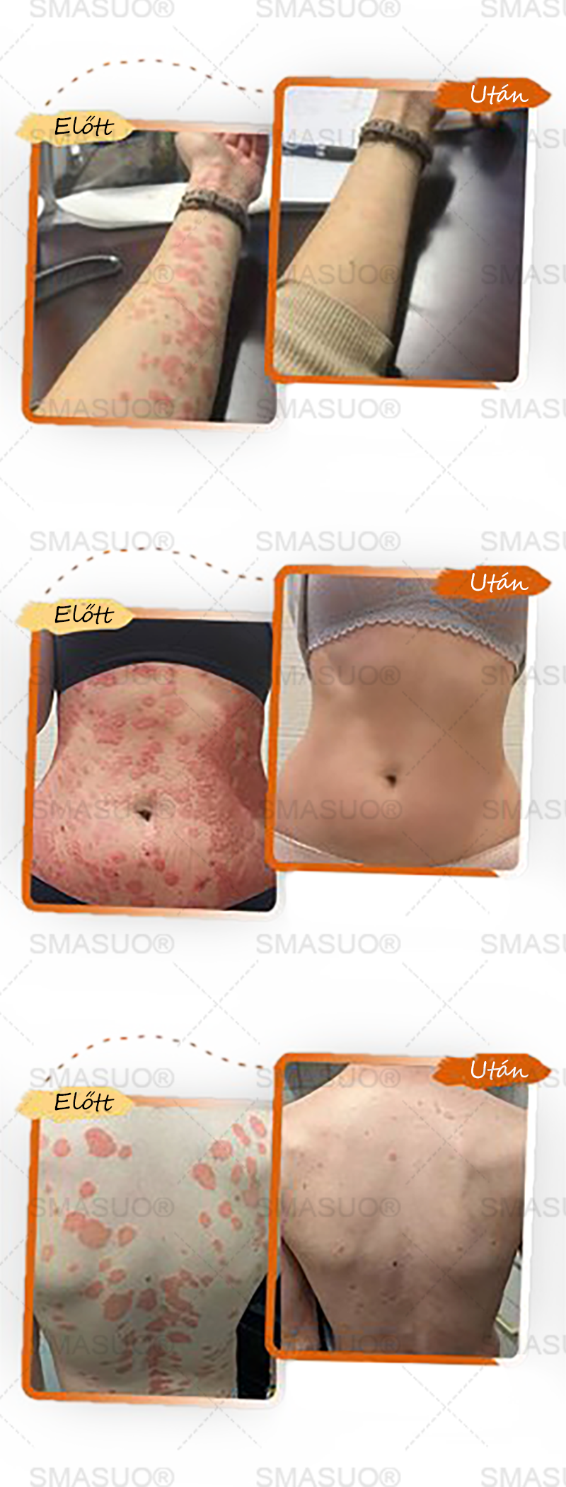 ✅ 𝙎𝙈𝘼𝙎𝙐𝙊® Fekete Rizses Bőrregeneráló Krém 👨‍⚕️ (Szemölcsök, bőrkinövések, foltok és hiperpigmentáció kezelésére)🍀