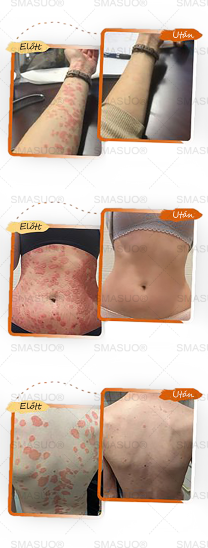 ✅ 𝙎𝙈𝘼𝙎𝙐𝙊® Fekete Rizses Bőrregeneráló Krém 👨‍⚕️ (Szemölcsök, bőrkinövések, foltok és hiperpigmentáció kezelésére)🍀