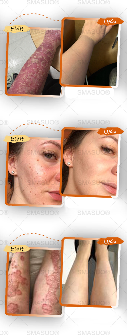 ✅ 𝙎𝙈𝘼𝙎𝙐𝙊® Fekete Rizses Bőrregeneráló Krém 👨‍⚕️ (Szemölcsök, bőrkinövések, foltok és hiperpigmentáció kezelésére)🍀