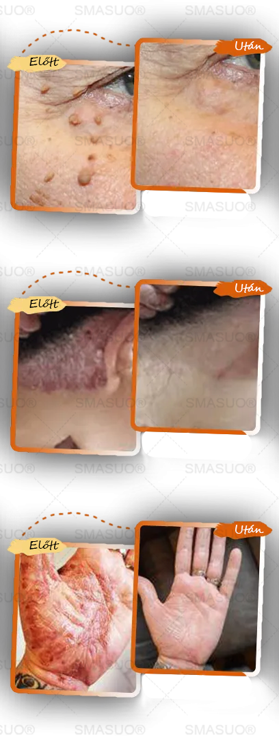 ✅ 𝙎𝙈𝘼𝙎𝙐𝙊® Fekete Rizses Bőrregeneráló Krém 👨‍⚕️ (Szemölcsök, bőrkinövések, foltok és hiperpigmentáció kezelésére)🍀