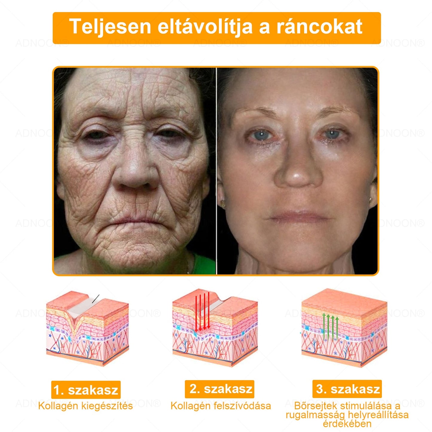 ADNOON® 🌼 🌼 Botox & Méregméz Feszesítő Krém - a bőr gyors regenerációját támogatja, a Magyar Bőrgyógyászati Társaság (MBT) által ajánlott 👨‍⚕️