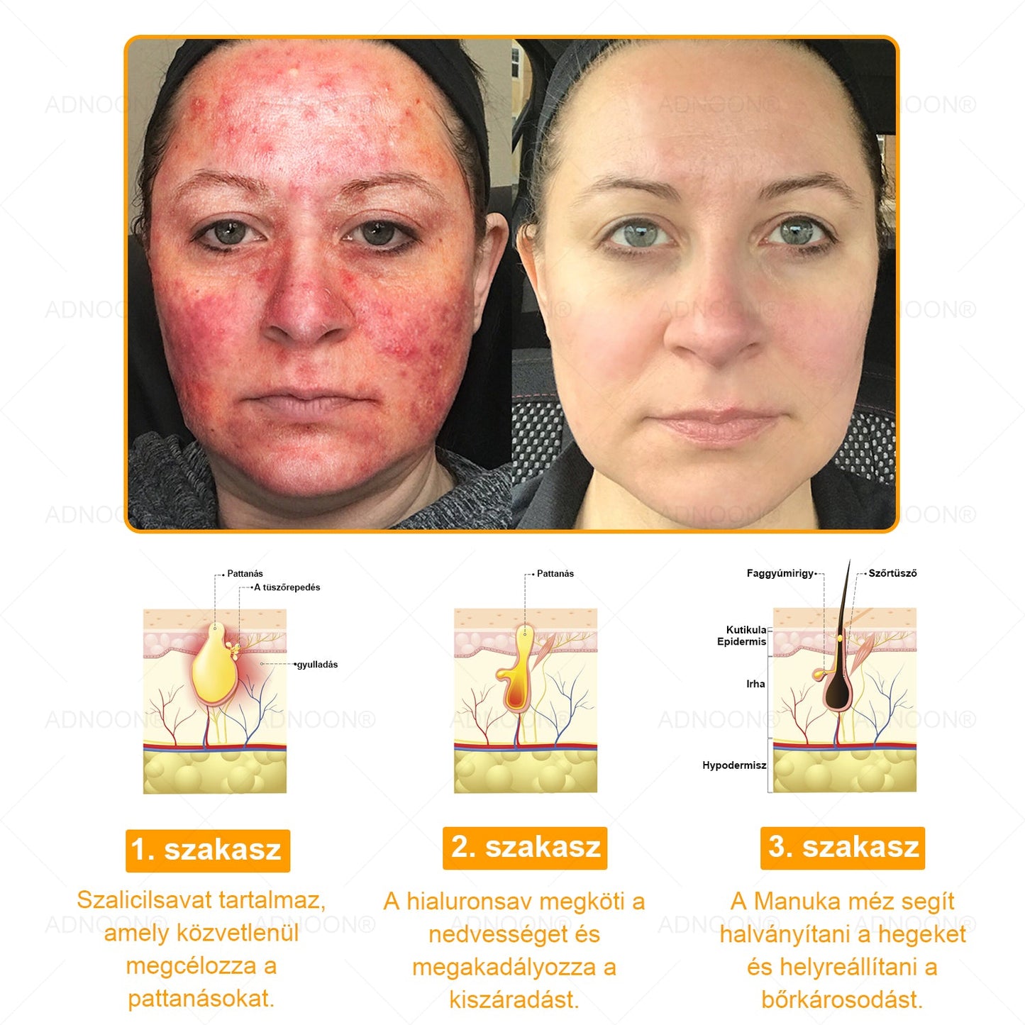 ADNOON® 🌼 🌼 Botox & Méregméz Feszesítő Krém - a bőr gyors regenerációját támogatja, a Magyar Bőrgyógyászati Társaság (MBT) által ajánlott 👨‍⚕️