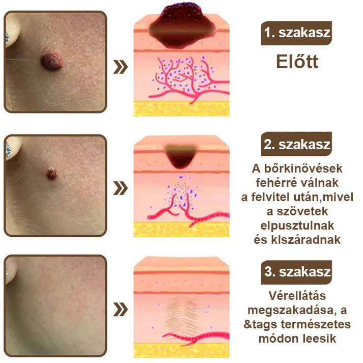 ✅ 𝙎𝙈𝘼𝙎𝙐𝙊® Fekete Rizses Bőrregeneráló Krém 👨‍⚕️ (Szemölcsök, bőrkinövések, foltok és hiperpigmentáció kezelésére)🍀